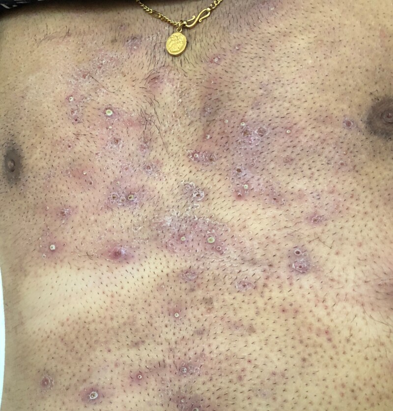 면도한 가슴의 털구멍을 중심으로 농포가 보이는 모낭염 실제 사진