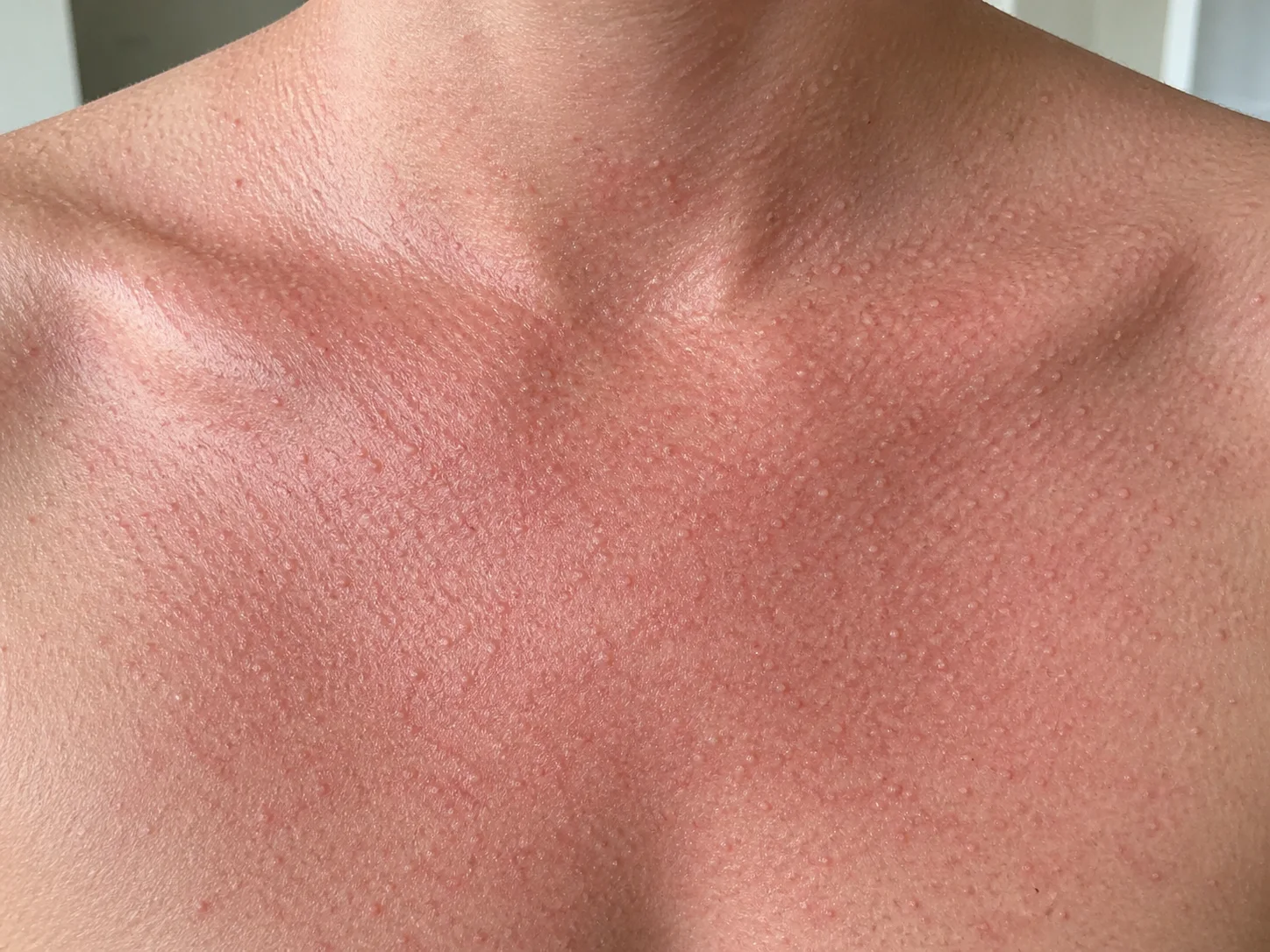 운동과 열 자극 뒤 성인 가슴 피부에 매우 작은 팽진과 붉은 테두리가 넓게 보이는 콜린성두드러기 교육용 예시