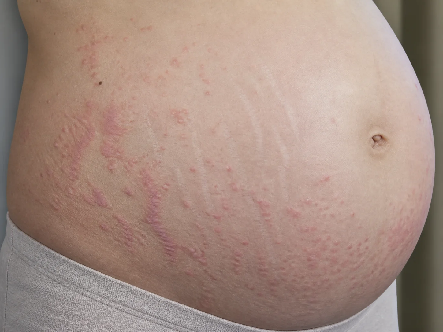 임신 복부의 튼살을 따라 작은 붉은 구진과 얇은 판이 퍼지고 배꼽 바로 주변은 비교적 비어 보이는 임신소양성 발진 교육용 예시