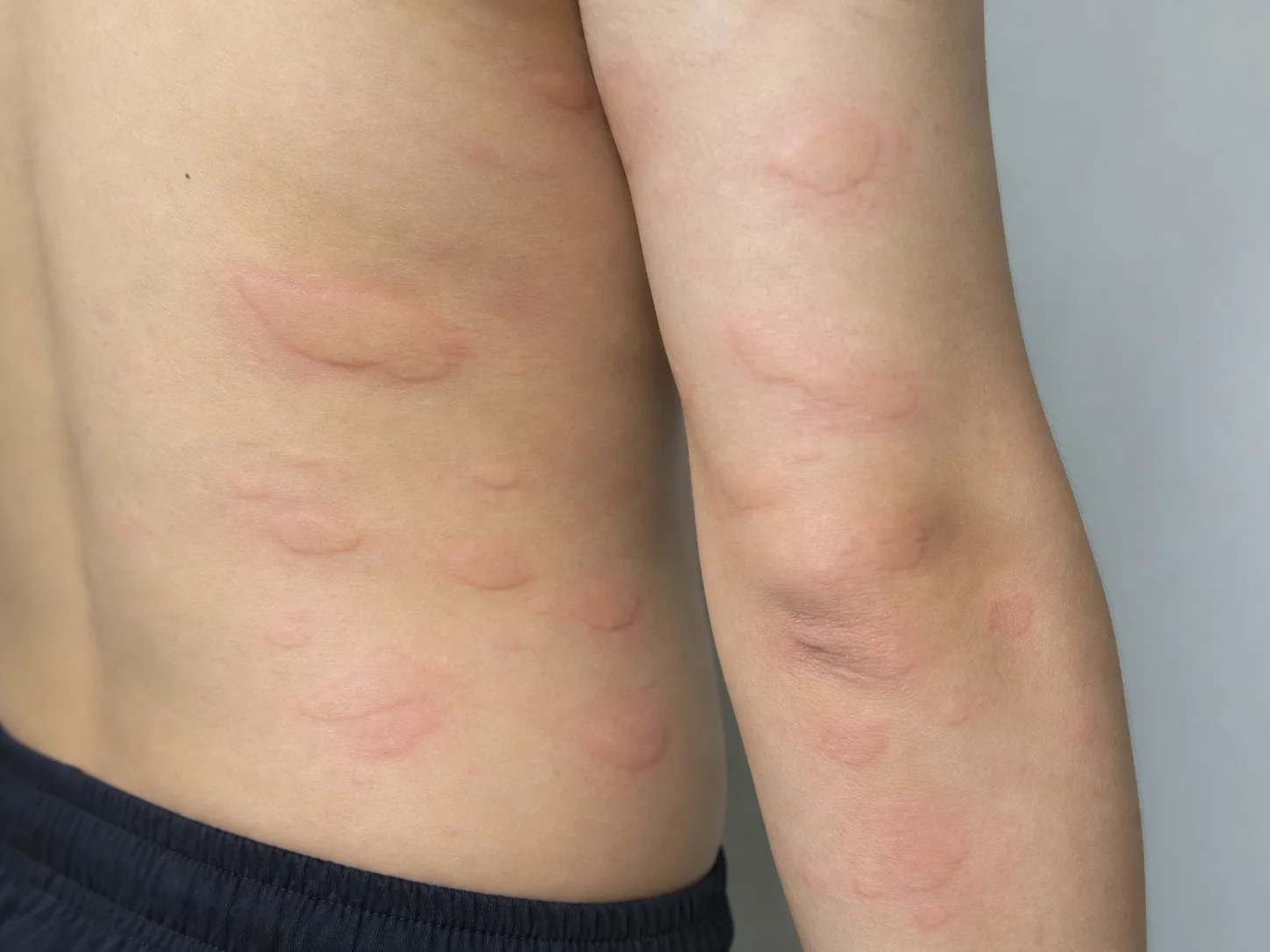 몸통과 팔에 여러 크기로 부드럽게 솟은 팽진을 보여주는 교육용 병변 재현 이미지